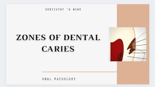 DENTAL CARIES ZONES [upl. by Neggem605]