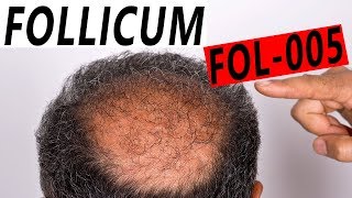 Follicum FOL 005 Anti Hair Loss Treatment UPDATE [upl. by Kawai]