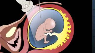 Prenatal test  Amniocentesis  Fetal medicine [upl. by Rawna3]