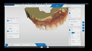 CEREC Design 7 Temporary Crown [upl. by Jephum]