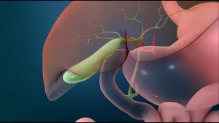 Surgery to Remove Your Gallbladder Open Cholecystectomy [upl. by Adam]