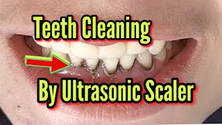 Teeth Cleaning By ultrasonic Scaler  TEETH SMILE RESTORATION [upl. by Ardnod398]