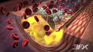 DiabetesRelated Atherosclerosis [upl. by Yhtomit]