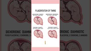 4 Types of twins medically Twin pregnancies pregnant youtubeshorts twins September 4 2024 [upl. by Esinereb]