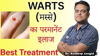 WARTS Best Treatment  मस्से का परमानेंट इलाज  Warts Homeopathic Treatment [upl. by Eirb]