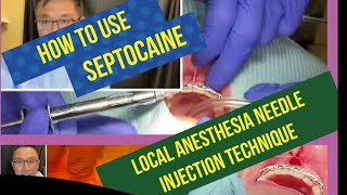 How to use Septocaine and Needle Injection Technique With Minimal Pain and Discomfort For Your Pt [upl. by Burns]