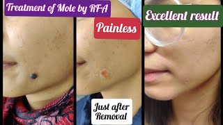 Mole removal by RFA  permanent removal of Melanocytic Nevus Dehradun  Treatment of Mole by RFA [upl. by Etiuqal]