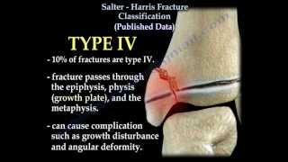 Salter Harris Fracture Classification  Everything You Need To Know  Dr Nabil Ebraheim [upl. by Wait367]