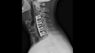 ACDF Bone Fusion Rates Recovery Timeline 2024 Four level Cervical Fusion [upl. by Drahnreb930]