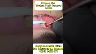 Wisdom Tooth Removal dentalcare dentist painlessdentistry wisdomtoothextraction [upl. by Anitsugua]