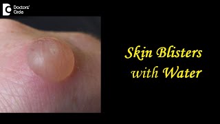 Skin Blisters with Water Causes Treatment Draining Prevention  DrAruna Prasad  Doctors Circle [upl. by Augy]