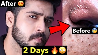 Remove Blackheads Whiteheads Naturally From Face  How to Remove Whiteheads Blackheads at Home [upl. by Asilegna128]