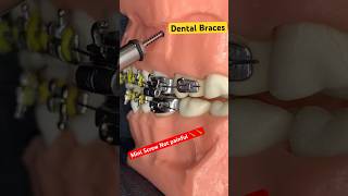 Mini Screw Braces  Orthodontics treatments [upl. by Imtiaz]