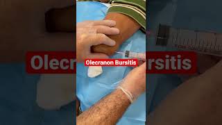 Olecranon Bursitis the fluid is taken out just like from a balloon by a Hand Surgery Specialist [upl. by Demodena]