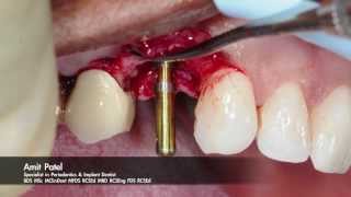 Onestage surgery using Tapered Internal PLUS dental implant from BioHorizons [upl. by Aloise]