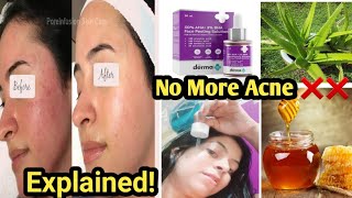 Secrets Revealed Acne Reduce ExplainedHow To Reduce pimple Causes  Prevention [upl. by Hey86]