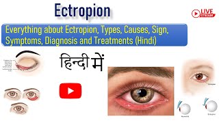 Everything about Ectropion Types Causes Sign Symptoms Diagnosis and Treatments Hindi [upl. by Langelo]