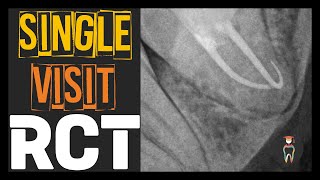 Single Visit Root Canal Treatment [upl. by Orland]