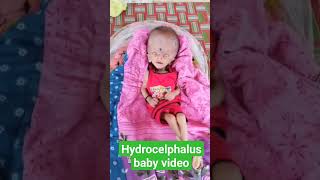 hydrocelphalus baby videohydrocephalus treatment without surgeryhydrocephalus [upl. by Chon939]