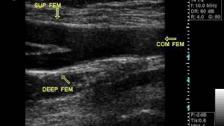 DOPPLER VASCULAR ULTRASOUND OPTIMAL VIEW OF COMMON ARTERYS BIFwmv [upl. by Oecam936]