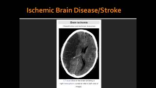 Ischemic Brain DiseaseStroke [upl. by Nudd]