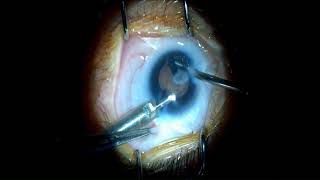 lensectomy proceduremicrocornea cataract surgerymicrophthalmiacoloboma of eye [upl. by Anirdnajela680]