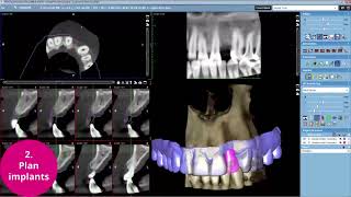 Planmeca Romexis – the complete dental implant workflow [upl. by Ranchod]