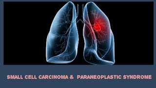 Small cell carcinoma  Paraneoplastic syndrome [upl. by Brubaker]