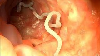 Man Has 20ft Tapeworm Inside Him [upl. by Debi]