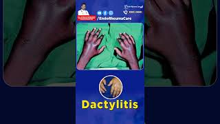 Understanding Dactylitis  Rheumatology amp Arthritis Doctor in Hyderabad  Dr Dheeraj Kondagari [upl. by Alyakam]