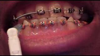 Week 33 in braces  massive movement [upl. by Eiramenna]