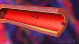 Infarctus du myocarde Symptômes Traitements Signes et Causes [upl. by Fariss473]