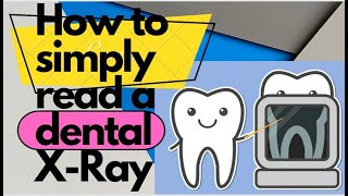 How To Understand Your Dental Xrays  How to Read Dental XRays Radiographic Interpretation [upl. by Anner]