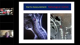 Craniocervical Instability in Hypermobile EDS  Jane R Schubart PhD amp Fraser C Henderson Sr MD [upl. by Titos]