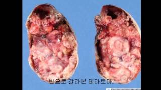 인체의 신비 테라토마약혐주의mystery of teratoma [upl. by Rodolph801]