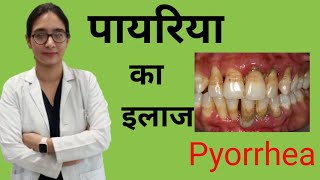 pyorrhea treatment at homeपायरिया का घरेलू इलाज  cure of pyorrheaperiodontitis treatment [upl. by Remmus]