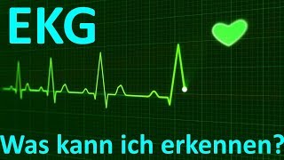 Was erkennt man beim EKG Monitoring 3Kanal [upl. by Adalia]