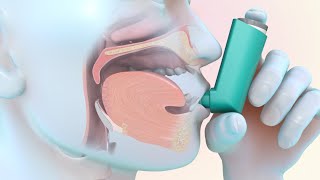 How to Use a MeteredDose Inhaler [upl. by Aidile218]