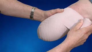 Wrapping Technique BK Residual Limb  Springer Prosthetic amp Orthotics Services [upl. by Berliner]