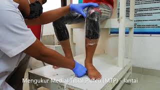 VIDEO PEMBELAJARAN LATIHAN CASTING TRANSFEMORAL QUADRILATERAL SOCKET [upl. by Jacki526]