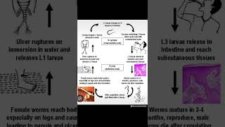 Guinea Worm [upl. by Landau370]