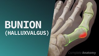 Bunion Hallux Valgus [upl. by Pammy]