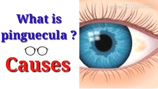 What is pinguecula  causes  clinical features  complication  Traetment [upl. by Lolly]