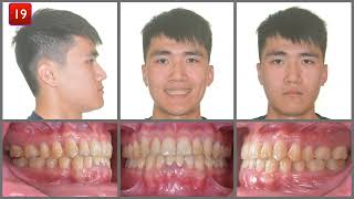 Solving anterior crossbite with Invisalign｜【Chris Chang Ortho】CC634 [upl. by Gnirol699]