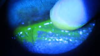 Scraping PseudoMembrane from under Eyelid with Adenovirus Infection [upl. by Lorilyn821]