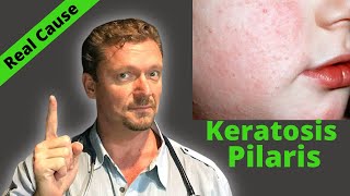 KERATOSIS PILARIS Fix Sign of Serious Condition Chicken Skin Cure [upl. by Landmeier]