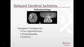 Monitoring for Delayed Cerebral Ischemia following Subarachnoid Hemorrhage Webinar English [upl. by Eiger193]