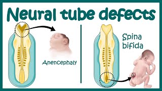 Neural Tube Defect  Overview  signs and symptoms of neural tube defect pathophysiology amp treatment [upl. by Aneek]