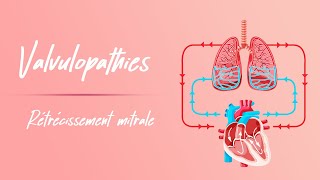 Rétrécissement mitral  Physiopathologie [upl. by Mayyahk]