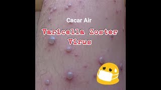 Varicella Zoster Virus atau Cacar Air [upl. by Roane840]